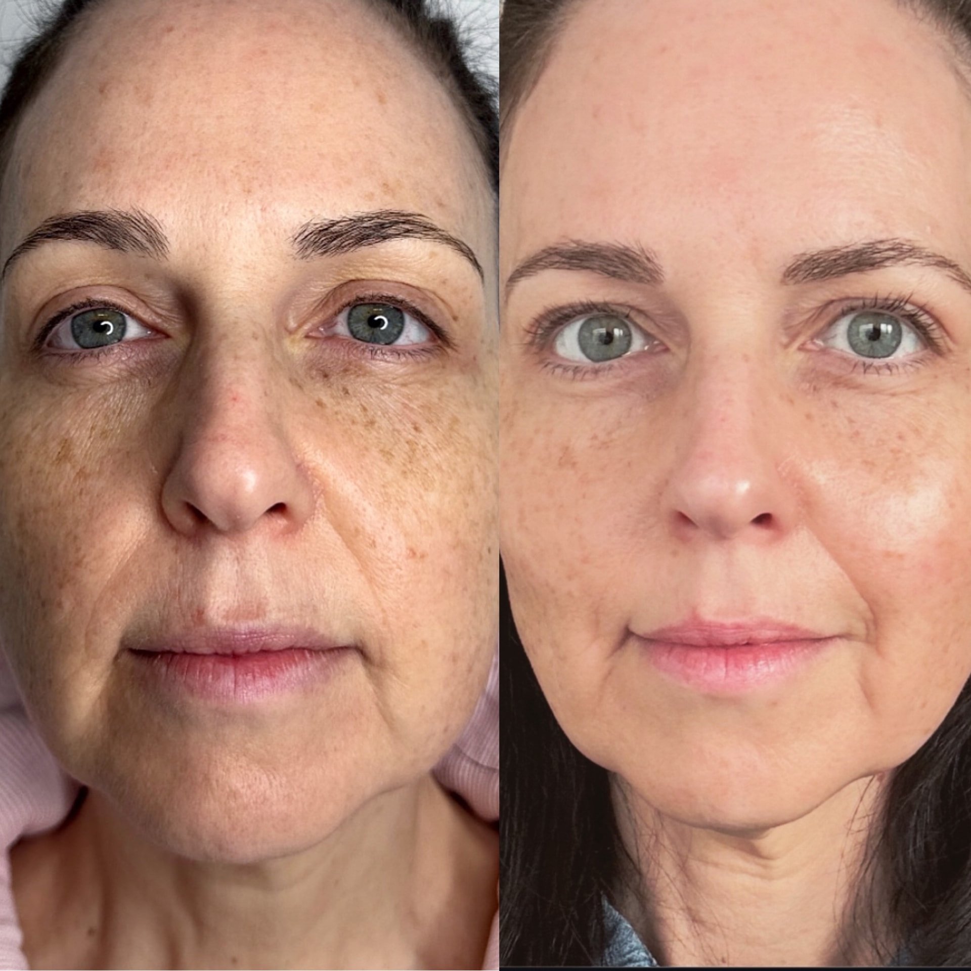 Neogen Face Lift results at iCRYO Westminster